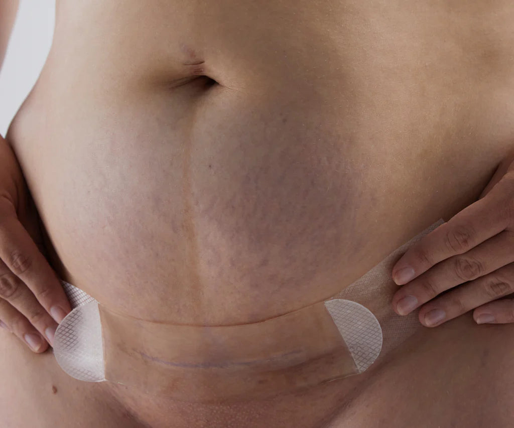 Bare Mum Silicon Gel Scar Strips Washable & Reusable